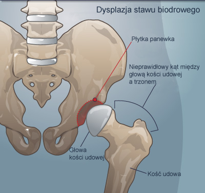 dla jakiego dziecka pieluchomajtki